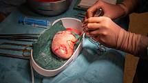 Specialisté z Urologické kliniky Fakultní nemocnice Olomouc využili k vyjmutí ledviny z těla žijícího dárce při příbuzenské transplantaci orgánu robotický systém da Vinci. Jednalo o vůbec první operaci tohoto druhu v České republice.