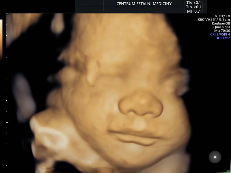 Moderní technologie umožňují rodičům získat nejen 3D snímek, nýbrž i 4D záznam, tedy rozpohybované 3D snímky ukazující reálný pohyb miminka v břiše matky. Zobrazení plodu na nejmodernějších zařízeních nabízejí v Centru fetální medicíny, které je součástí 