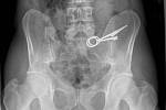 Rozlomené nůžky jsou na digitálním snímku z vyšetření vězňova břicha dobře patrné.