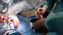 Specialisté z Urologické kliniky Fakultní nemocnice Olomouc využili k vyjmutí ledviny z těla žijícího dárce při příbuzenské transplantaci orgánu robotický systém da Vinci. Jednalo o vůbec první operaci tohoto druhu v České republice.