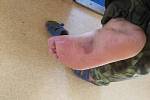 Zraněná noha. Hasiče před vážnějšími následky ochránila hlavně zásahová obuv. I tak si ale léčba vyžádá až několik dní.