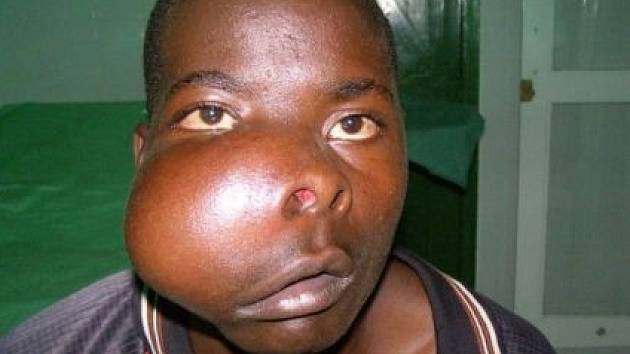 Již dva roky bují chudému keňskému chlapci ve tváři nádor.