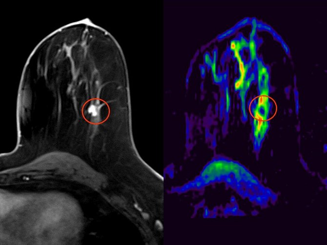 Na fotografii je v kroužku vidět malý nádor levého prsu, tmavý odstín nádorové tkáně na barevné mapě pak prokazuje jeho maligní neboli zhoubnou povahu