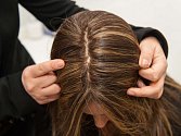 Třetina lidí má problémy s vypadáváním vlasů. Pomoci může nová metoda.
