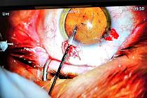 Operace oka: První v Evropě v příbramské nemocnici. Ilustrační foto