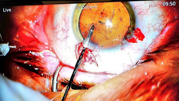 Operace oka: První v Evropě v příbramské nemocnici. Ilustrační foto