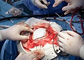 Neurochirurgové z českobudějovické nemocnice uskutečnili unikátní operace dvěma pacientům,přičemž jim nahradili část lebeční kosti biokeramickým materiálem