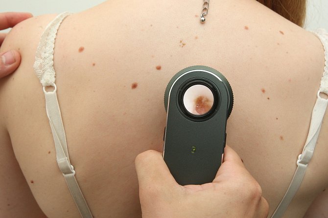 Evropský den melanomu každoročně odhalí při bezplatném vyšetření zájemců v celé České republice přes stovku zhoubných kožních nádorů.