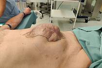 Novou metodu při operacích kýly používají chirurgové ve Fakultní nemocnici u svaté Anny v Brně.