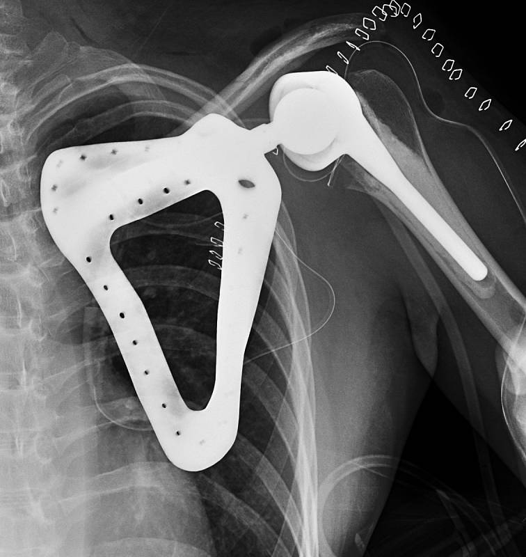 Vytvořili postříbřenou náhradu z titanu a vložili ji nemocnému na místo jeho vlastní lopatky. Unikátní operaci provedli minulý týden lékaři z Fakultní nemocnice u svaté Anny v Brně.