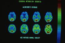 Počítačový scan mozku zasaženého Alzheimerovou chorobou. Ilustrační foto.