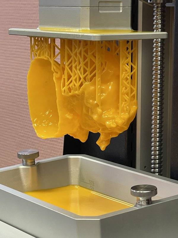 Ve Fakultní nemocnici Brno jsou nově schopni na 3D tiskárně vytisknout dokonalý model takového srdce a rozhodnout o nejvhodnějším postupu při operaci.