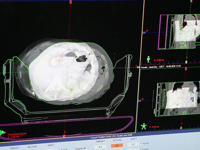 Radioterapie takzvaným X-nožem v Masarykově onkologickém centru na Žlutém kopci.