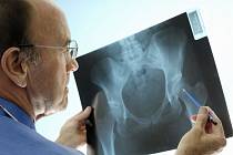 Osteoporózou trpí každý patnáctý Čech, více trápí ženy. Ilustrační foto.