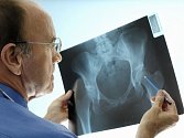Osteoporózou trpí každý patnáctý Čech, více trápí ženy. Ilustrační foto.