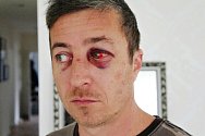 Jan Rytíř má po zranění obličeje trvalé následky. Špatně vidí na jedno oko.