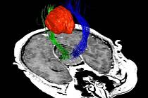 Mozkový nádor - ilustrační foto.