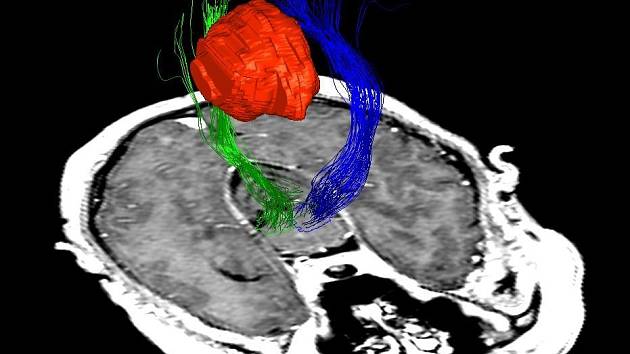 Mozkový nádor - ilustrační foto.