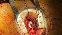 Pohled na operační přístup přes srdeční hrot s již implantovanou a fixovanou chlopní.