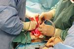 Ústečtí kardiochirurgové společně s primářem motolské kardiochirurgie Romanem Gebauerem vytvořili pacientovi novou srdeční chlopeň z části jeho vlastního osrdečníku.