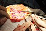 Ústečtí kardiochirurgové společně s primářem motolské kardiochirurgie Romanem Gebauerem vytvořili pacientovi novou srdeční chlopeň z části jeho vlastního osrdečníku.