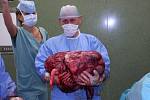 Zlínští lékaři ženě odoperovali 36 kilo vážící nádor
