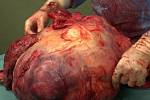 Zlínští lékaři ženě odoperovali 36 kilo vážící nádor