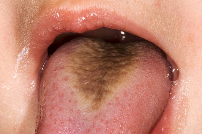 Chlupatý jazyk. Málo vídané onemocnění způsobil papilovirus.