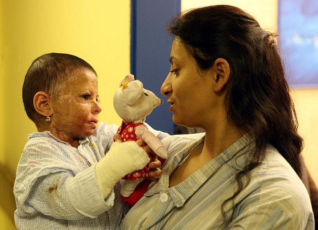 Popálená tříletá Natálka v maminčině náručí před odchodem z nemocnice.