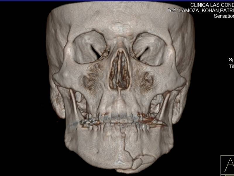 CT snímek lebky a prasklé čelisti Ondry Banka.