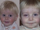 Na jedné z posledních fotek (snímek vlevo) je Veronika Opelková naprosto zdravým dítětem. Na snímku vpravo je Veronika týden po nehodě, kdy mohla oko otevřít aspoň napůl.