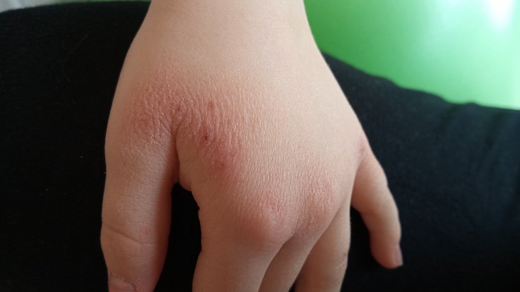 Ruce dítěte zničené dezinfekcí proti koronaviru. Ilustrační foto.