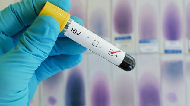 Pozitivní test HIV. Ilustrační foto.