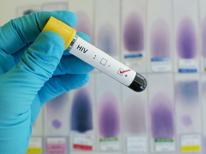 Pozitivní test HIV. Ilustrační foto.