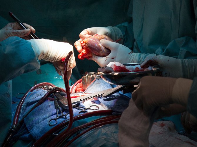 Takhle vypadá transplantace srdce. První provedli v pražském IKEM poprvé na konci ledna 1984.