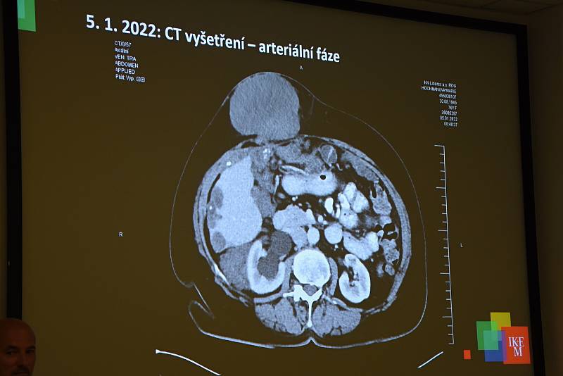 Rizika spojená s nákazou echinokokózou představili v pátek odborníci v Institutu klinické a experimentální medicíny.