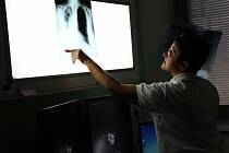 Mezi základní vyšetření při podezření na IPF patří rentgen plic.