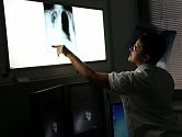 Mezi základní vyšetření při podezření na IPF patří rentgen plic.