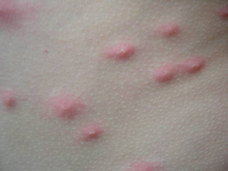 Cerkáriová dermatitida - ilustrační foto.