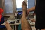 Takhle dopadla pravá noha Kamila Podolského po střetu s brankářem Litoměřicka.